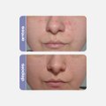 SÉRUM FACIAL ANTIACNE CREAMY PRO-ADAPALENO 30G
