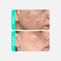 TÔNICO ANTIACNE ESFOLIANTE CREAMY ÁCIDO SALICÍLICO 90ML